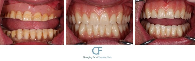 Wax Bite For Dentures Springfield MA 1138